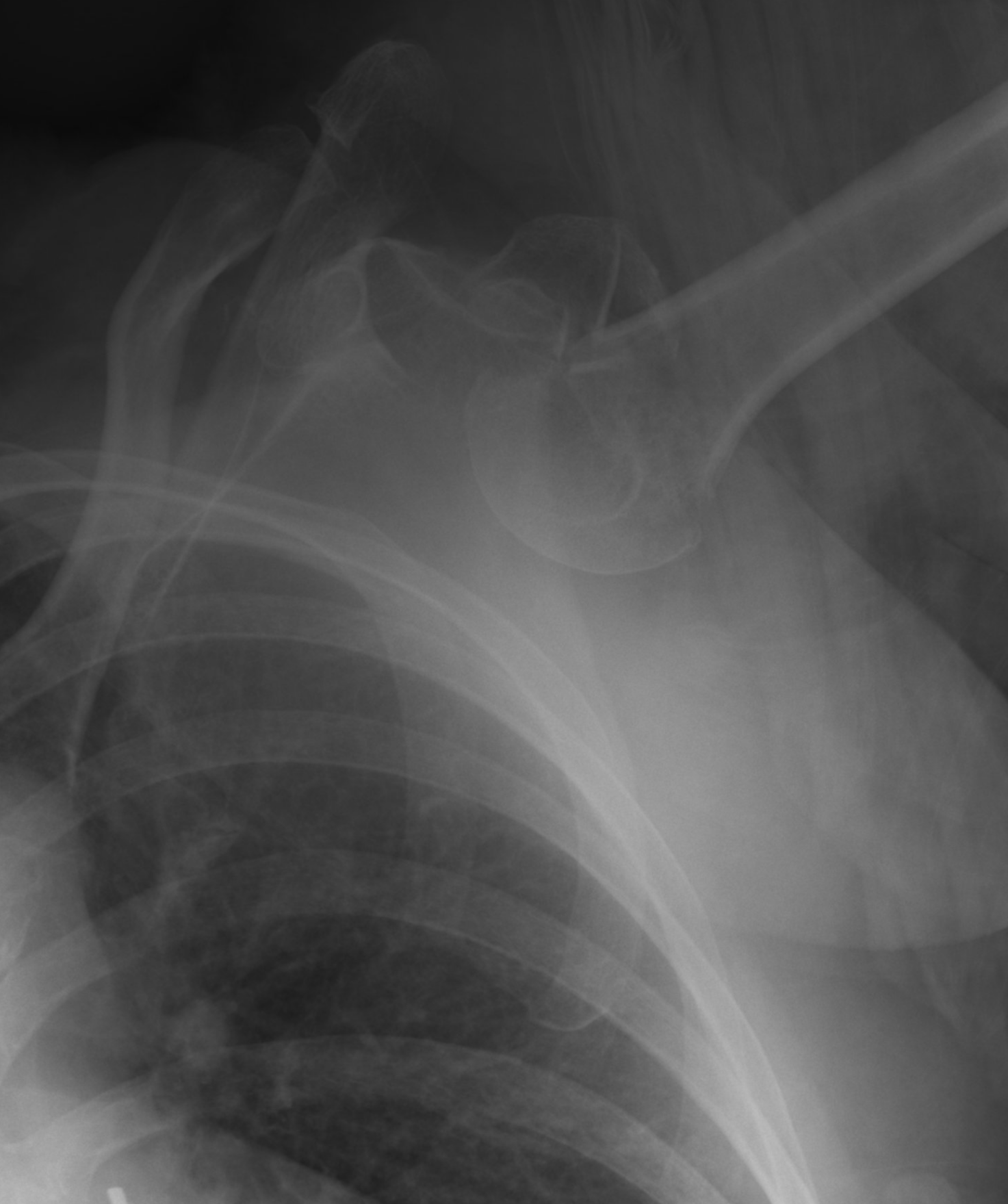 Luxatio erecta - inferior shoulder dislocation with fracture of ...