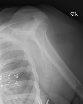 Luxatio erecta - inferior shoulder dislocation with fracture of ...