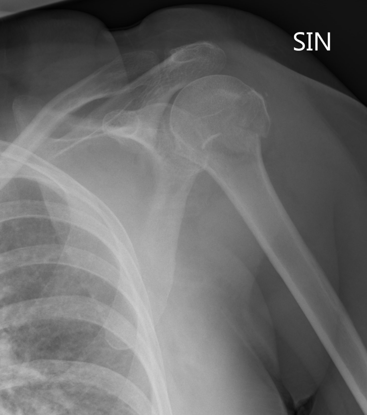 Luxatio erecta - inferior shoulder dislocation with fracture of ...