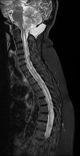 Pseudomeningocele | Image | Radiopaedia.org