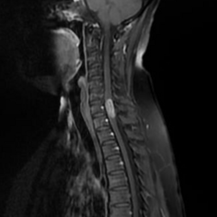 Spinal schwannoma | Radiology Case | Radiopaedia.org