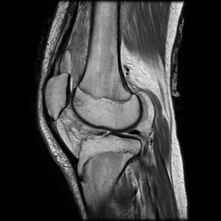 Septic arthritis of the knee | Image | Radiopaedia.org