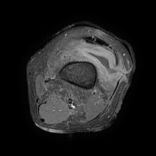 Septic arthritis of the knee | Image | Radiopaedia.org