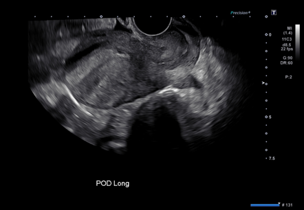 ectopic pregnancy case study pdf