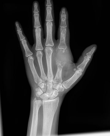 Giant cell tumor of the metacarpal bone | Radiology Case | Radiopaedia.org