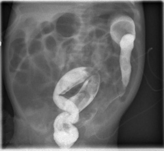 Waardenburg Shah Syndrome Image