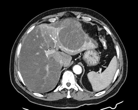 Acutely ruptured and infarcted hepatocellular carcinoma | Radiology ...