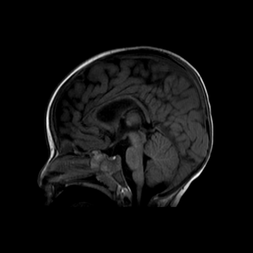 Waardenburg Shah Syndrome Image