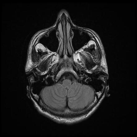 Idiopathic intracranial hypertension | Image | Radiopaedia.org