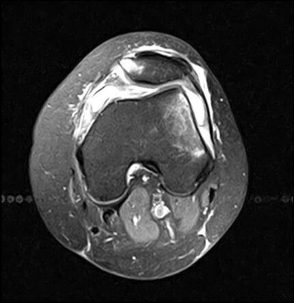 Transient lateral patellar dislocation | Radiology Case | Radiopaedia.org