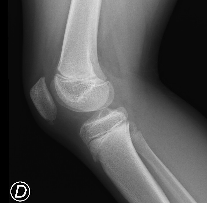 Sinding-larson-johansson (slj) Syndrome And Distal Femoral Cortical 