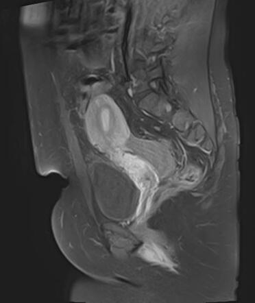 Peritoneal inclusion cyst | Image | Radiopaedia.org