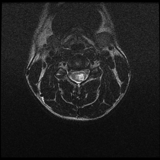 Chiari 1.5 malformation | Image | Radiopaedia.org