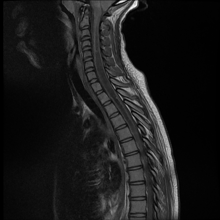 Chiari 1.5 malformation | Image | Radiopaedia.org