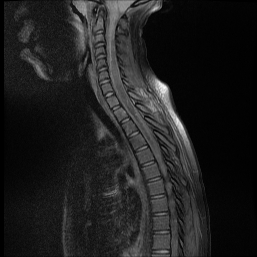 Chiari 1.5 malformation | Image | Radiopaedia.org