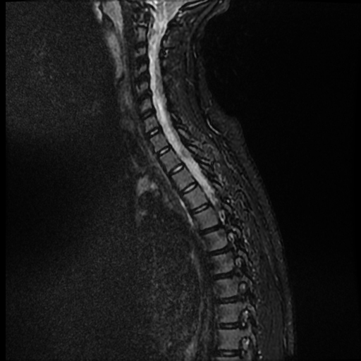 Chiari 1.5 malformation | Image | Radiopaedia.org