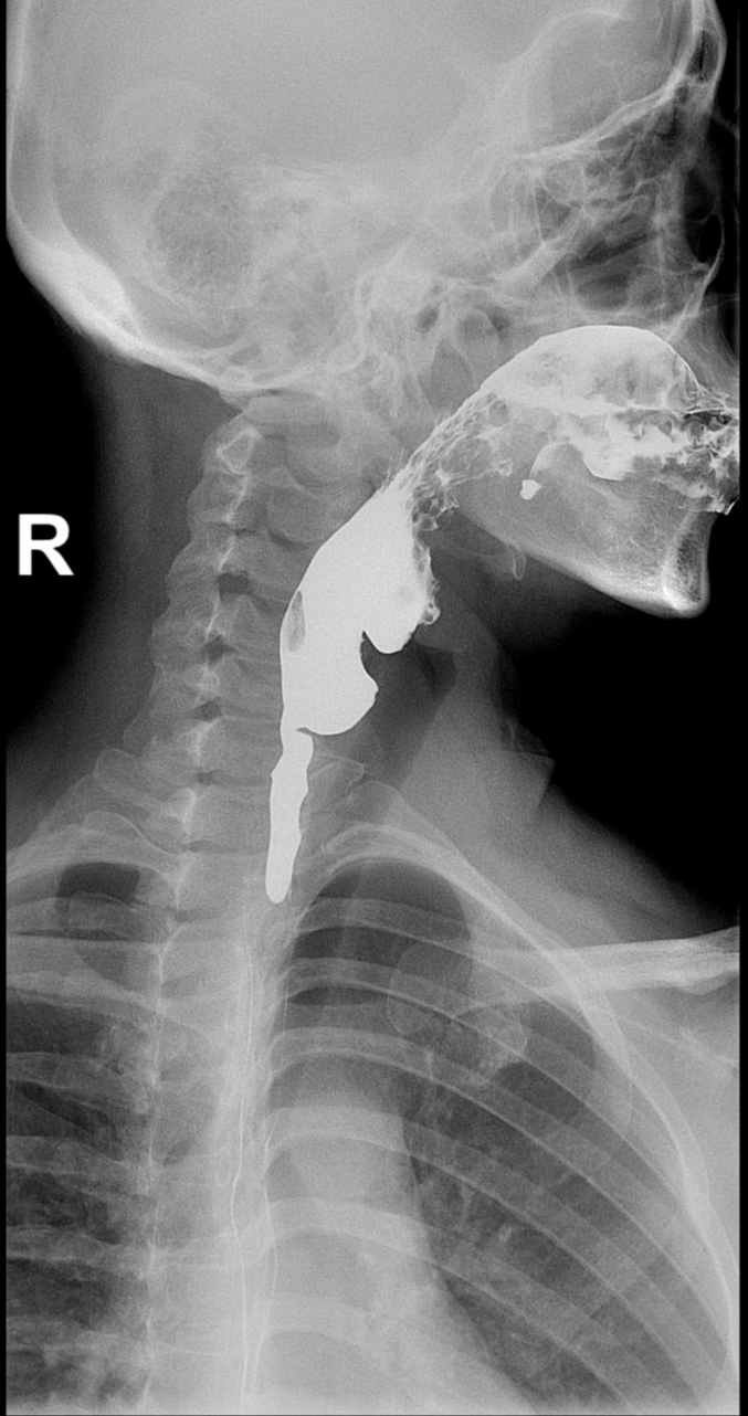 Esophageal Web With Proximal Dilatation And Diverticulum