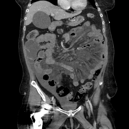 Petersen internal hernia resulting in volvulus of the entire small ...