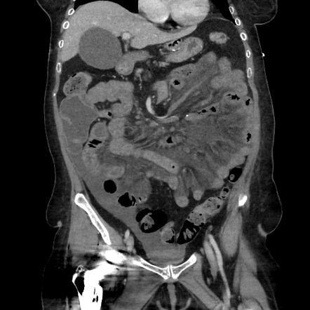 Petersen hernia | Radiology Reference Article | Radiopaedia.org