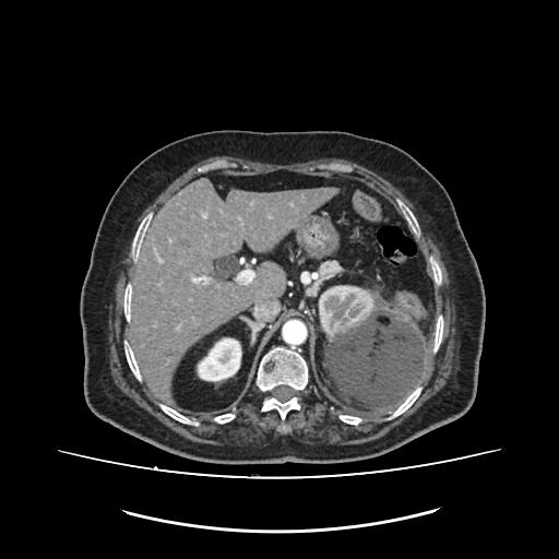 Wunderlich syndrome | Image | Radiopaedia.org