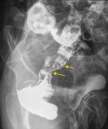 Rectal Cancer | Radiology Reference Article | Radiopaedia.org