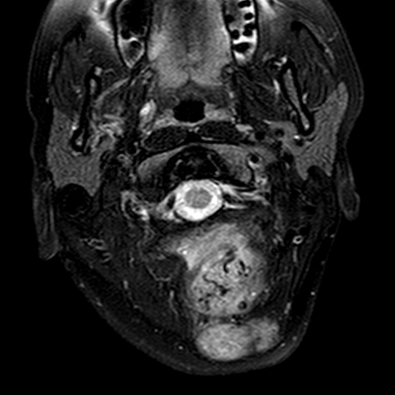 Intramuscular hemangioma - suboccipital neck | Radiology Case ...