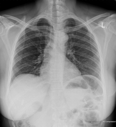 Bilateral subphrenic sterilisation clips | Radiology Case | Radiopaedia.org