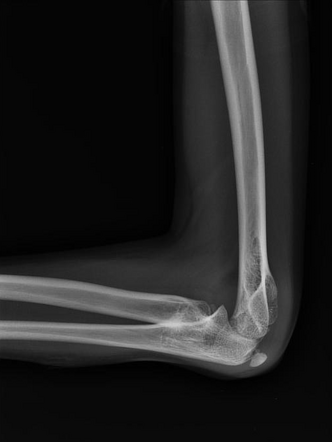 Proximal radioulnar synostosis | Image | Radiopaedia.org