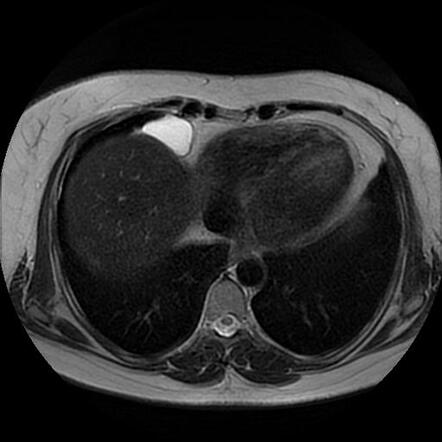 Pericardial cyst | Radiology Case | Radiopaedia.org