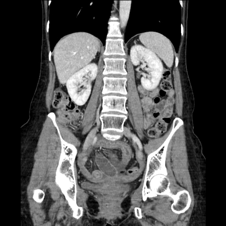 Radiation-induced enteritis resulting in small bowel obstruction ...