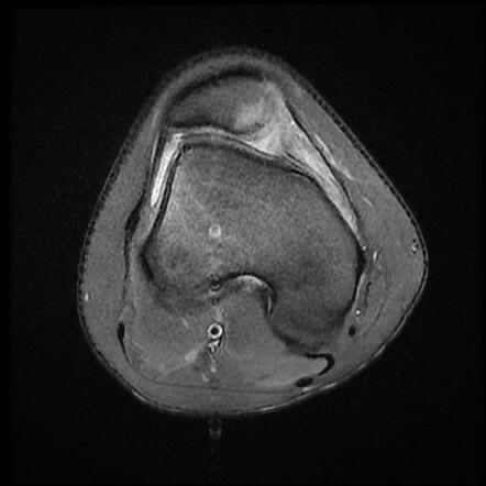 patellar dislocation rt icd 10