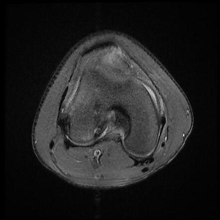 Lateral patellar dislocation | Radiology Case | Radiopaedia.org