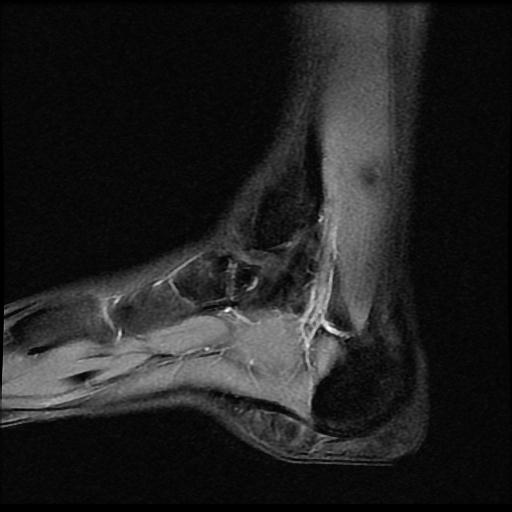 Accessory soleus muscle | Image | Radiopaedia.org