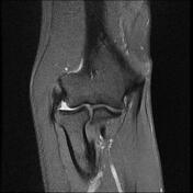 Lateral epicondylitis | Radiology Reference Article | Radiopaedia.org