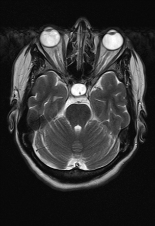 presentation of benign intracranial hypertension