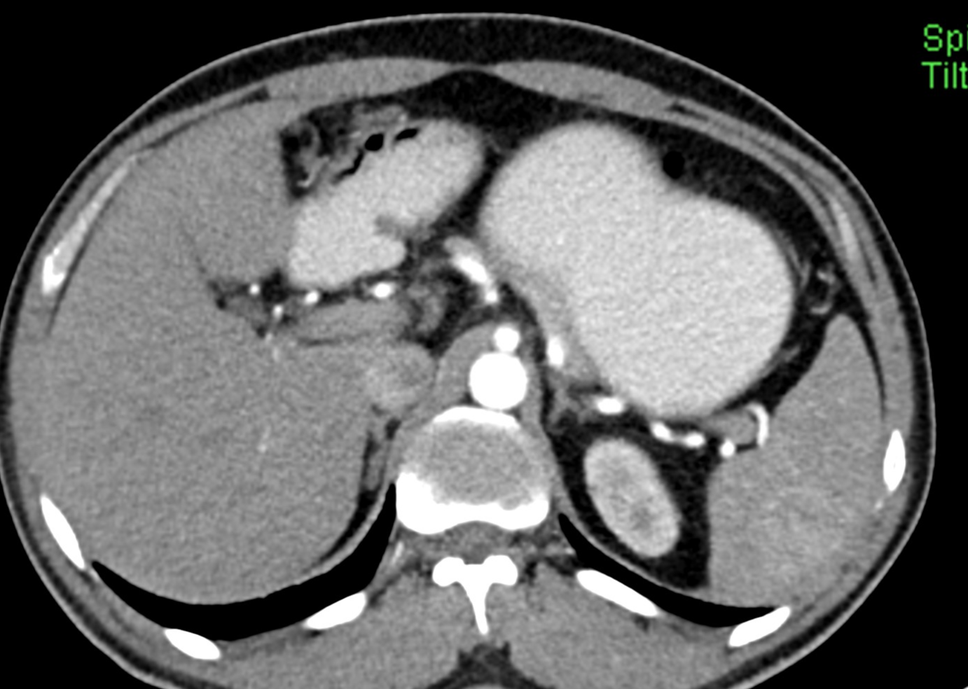 Celiac artery compression syndrome | Image | Radiopaedia.org