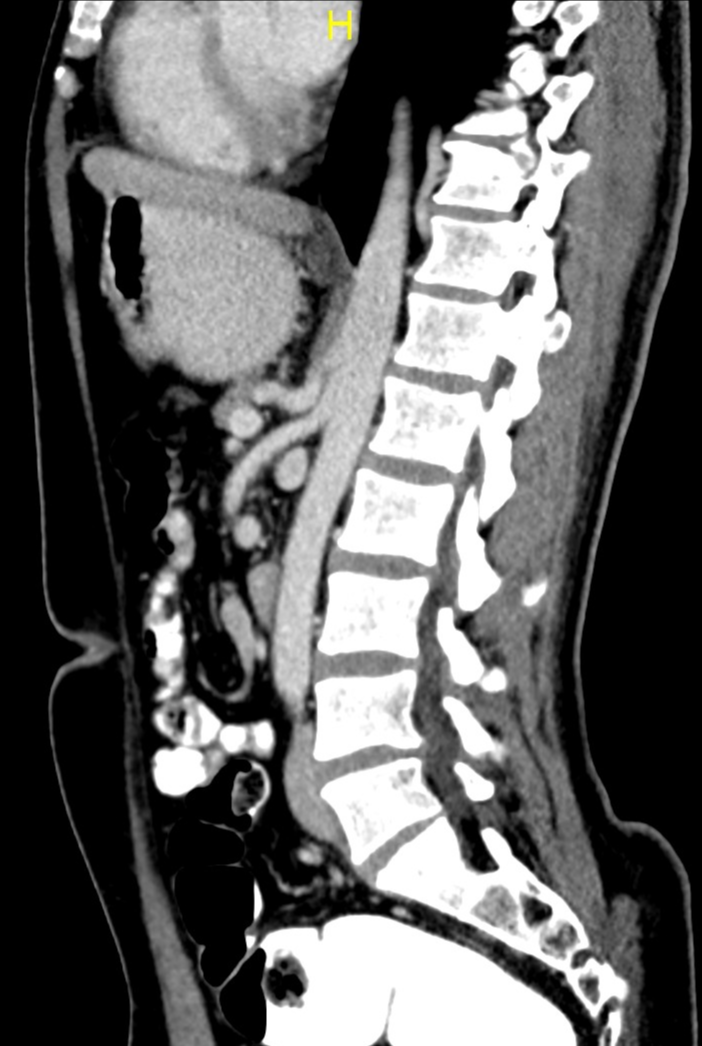 Celiac Artery Compression Syndrome Image