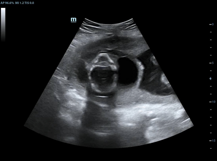 Cystic hygroma | Radiology Case | Radiopaedia.org