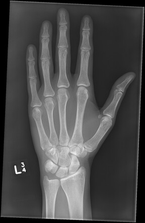 Metacarpal head fracture | Image | Radiopaedia.org