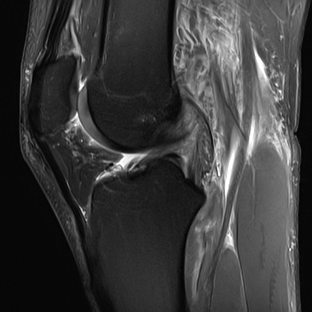 Posterior Cruciate Ligament Injury With Posterolateral Corner Injury 