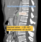 Superior mesenteric artery syndrome | Radiology Reference Article ...