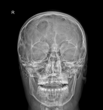 Eosinophilic granuloma - skull | Radiology Case | Radiopaedia.org