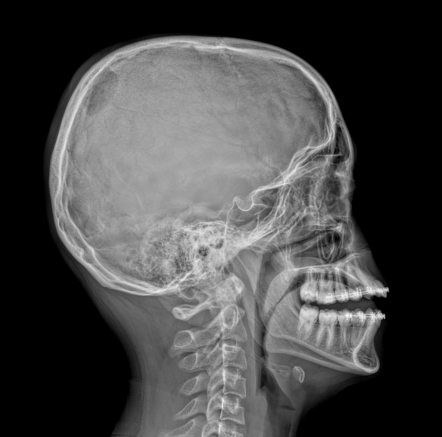 Eosinophilic granuloma - skull | Image | Radiopaedia.org