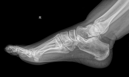 Stress fracture - base of 5th metatarsal bone | Image | Radiopaedia.org