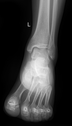 Foreign body - foot | Image | Radiopaedia.org