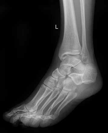 Foreign body - foot | Image | Radiopaedia.org