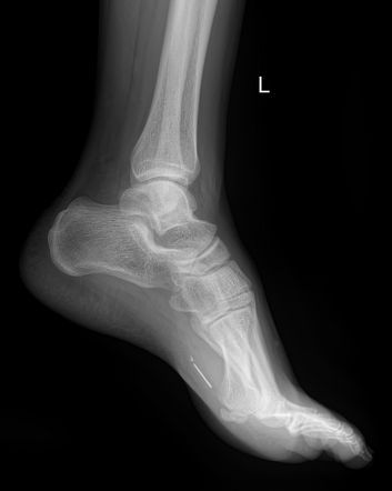 Foreign body - foot | Image | Radiopaedia.org