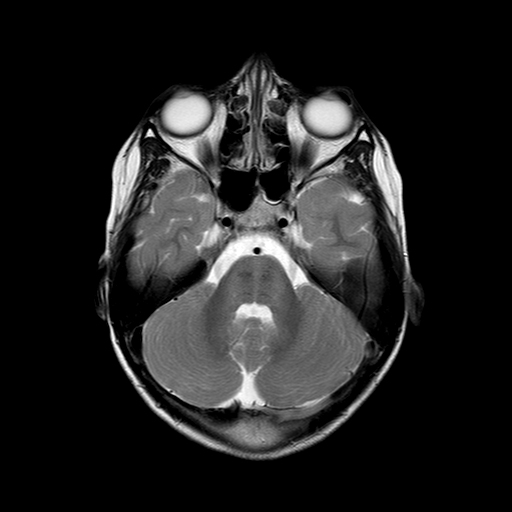 Autosomal recessive spastic ataxia of Charlevoix-Saguenay | Image ...