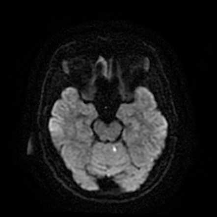 CT-negative cerebellar stroke - subtle | Radiology Case | Radiopaedia.org