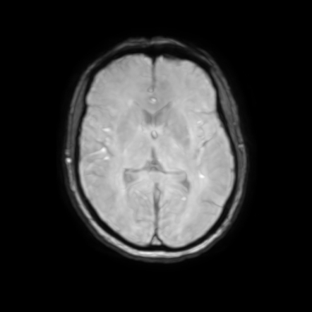 CT-negative cerebellar stroke - subtle | Image | Radiopaedia.org